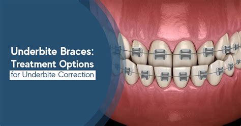 underbite metal bracket|how to fix underbite.